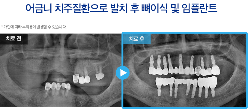 임플란트 증례1