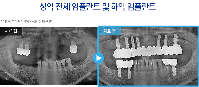 임플란트 증례2