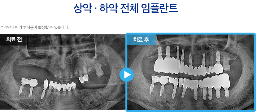 임플란트 증례3