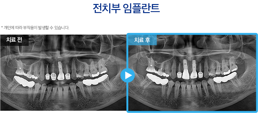 임플란트 증례4