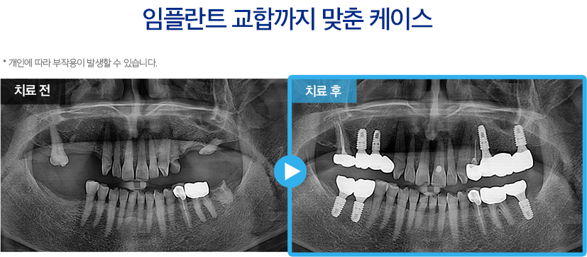 임플란트 증례5