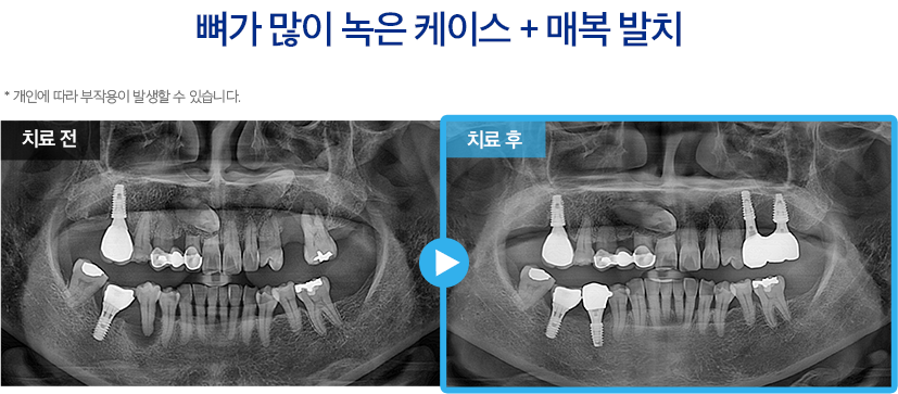 임플란트 증례6