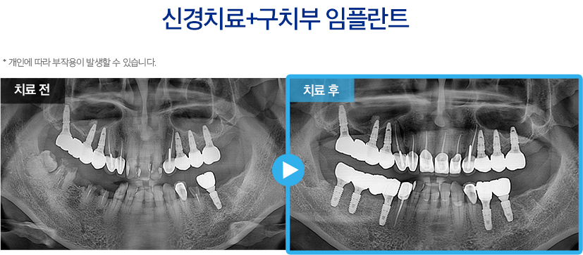 임플란트 증례7