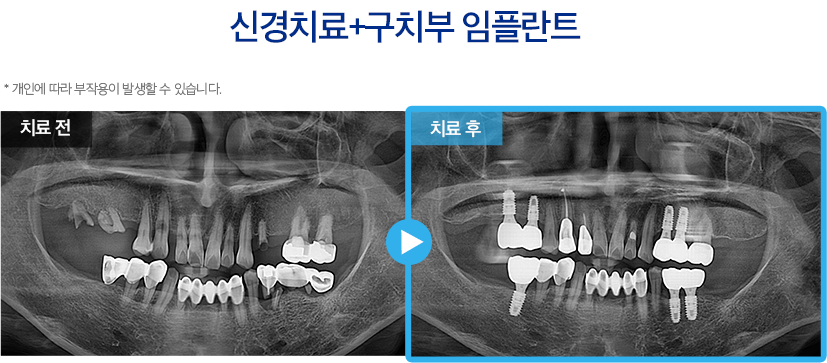 임플란트 증례8