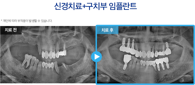 임플란트 증례9