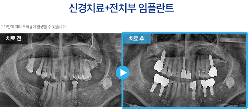 임플란트 증례10