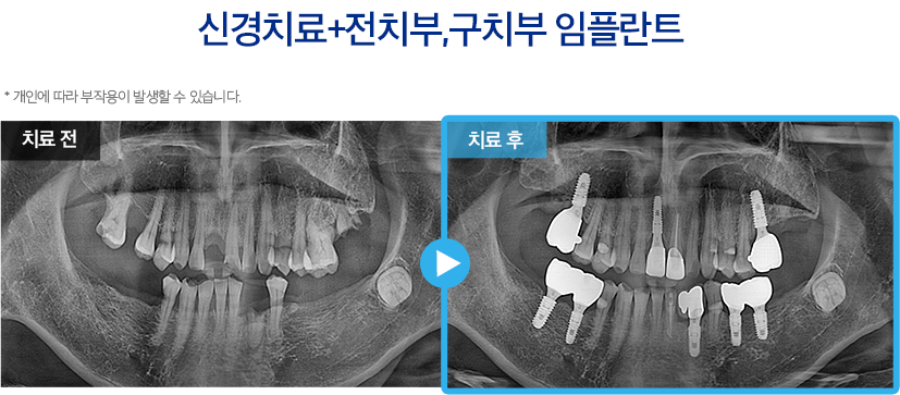 임플란트 증례11