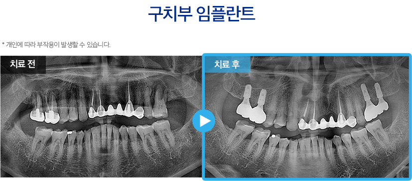 임플란트 증례12