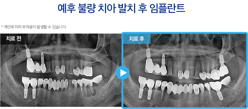 임플란트 증례13