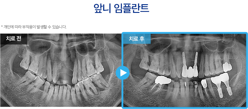 임플란트 증례14