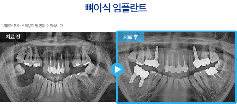 임플란트 증례15