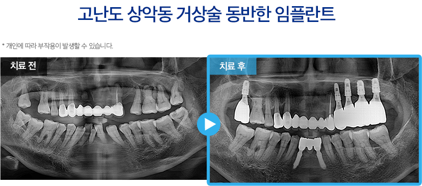 임플란트 증례16