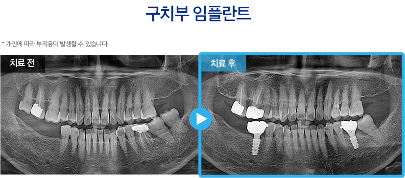 임플란트 증례17