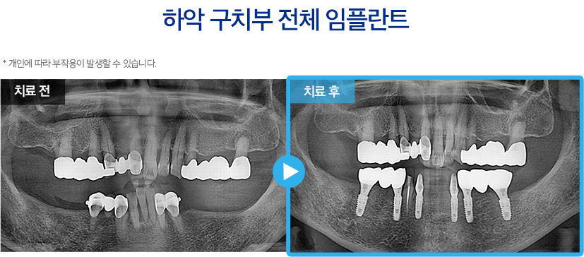 임플란트 증례18