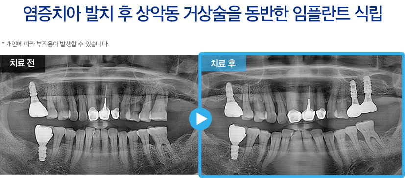 임플란트 증례19