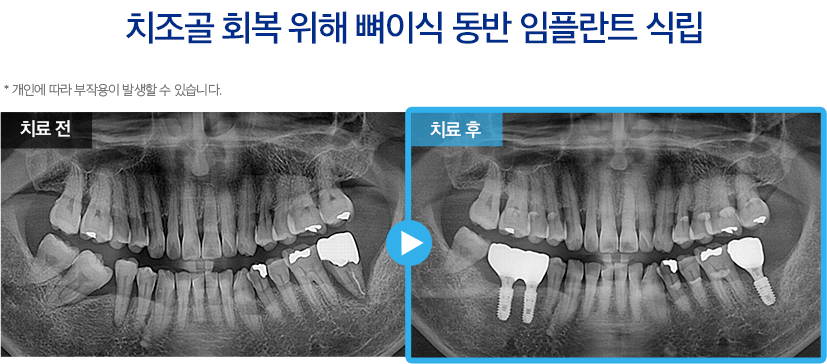 임플란트 증례20