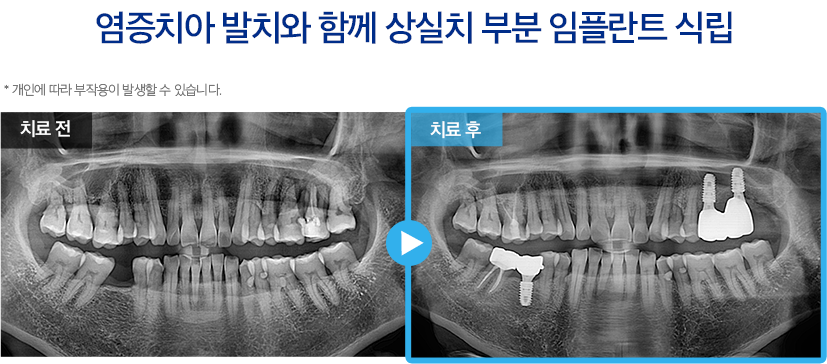 임플란트 증례21