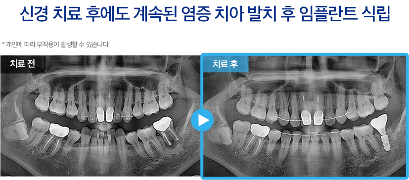 임플란트 증례22