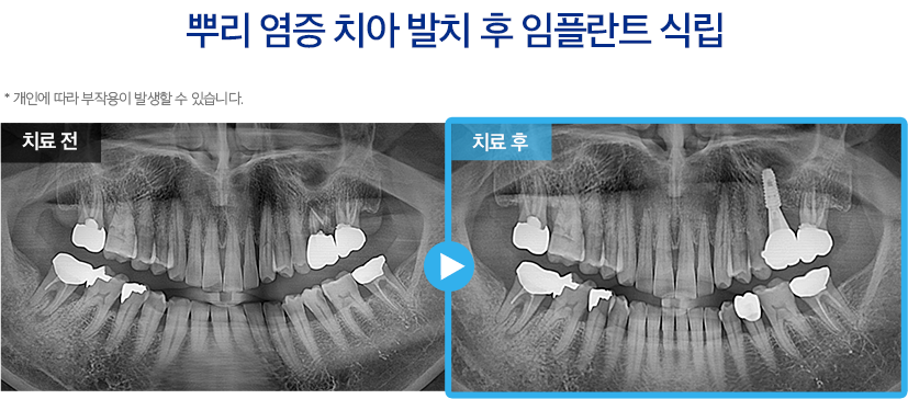 임플란트 증례23