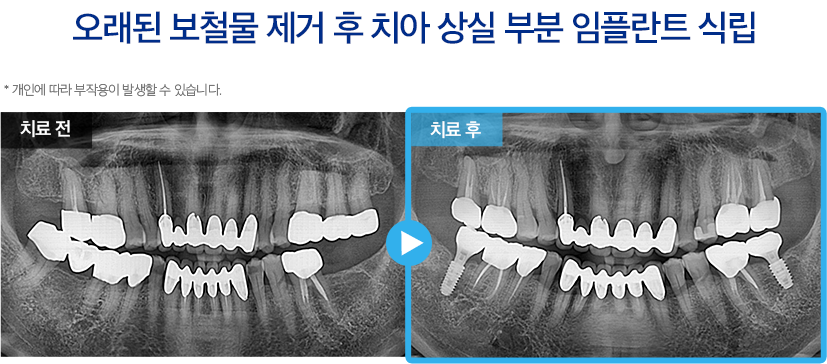 임플란트 증례24