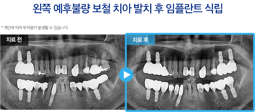 임플란트 증례25