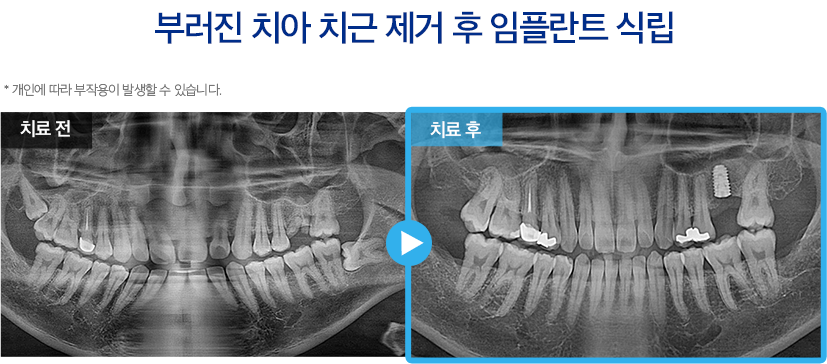 임플란트 증례26