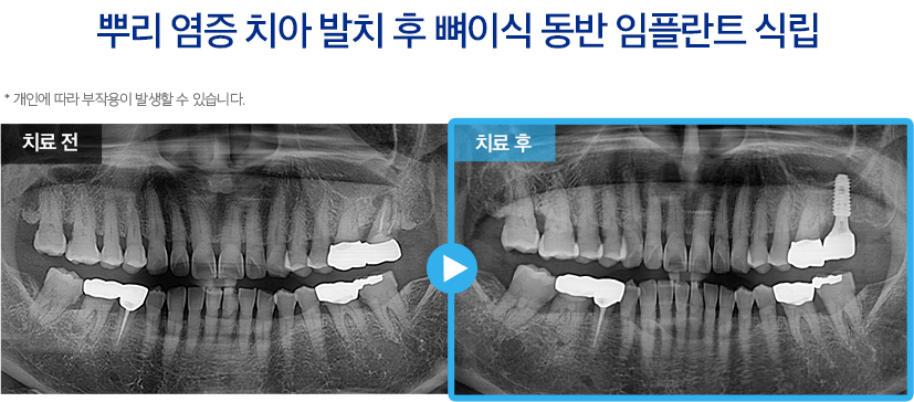 임플란트 증례27