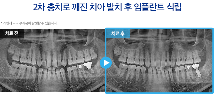 임플란트 증례28