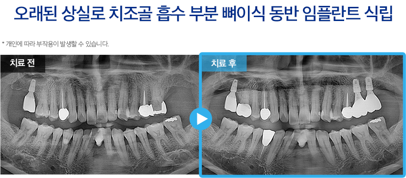 임플란트 증례29