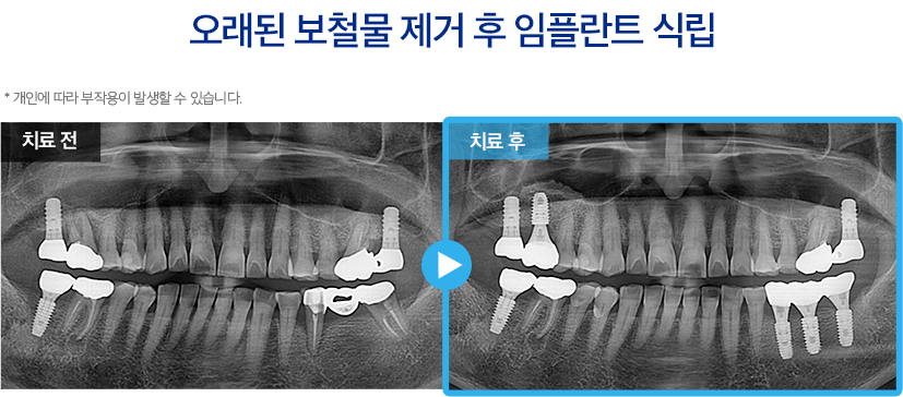 임플란트 증례30