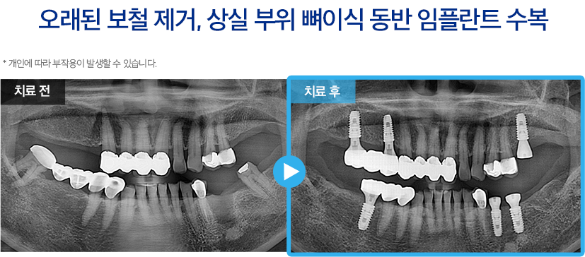 임플란트 증례31