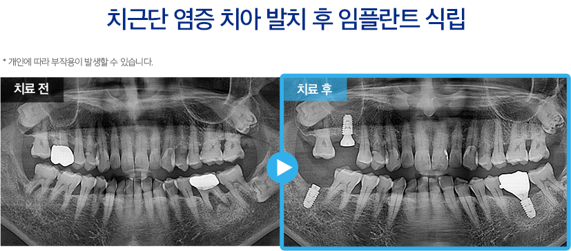 임플란트 증례32