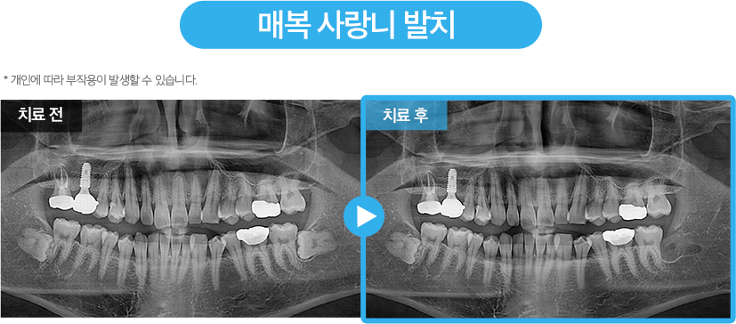 사랑니 증례1