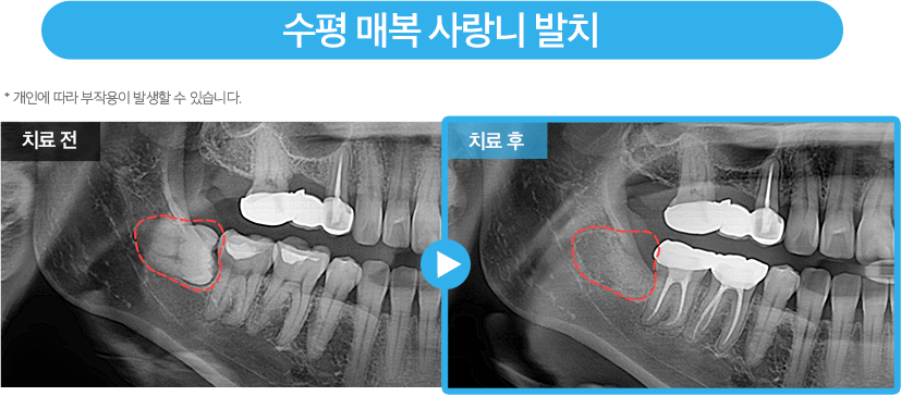 사랑니 증례2