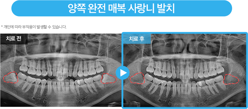 사랑니 증례3