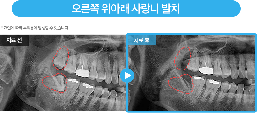 사랑니 증례4