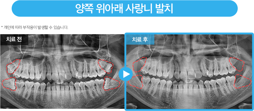 사랑니 증례5