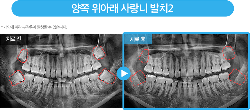 사랑니 증례6