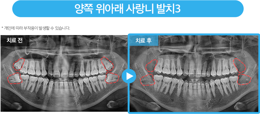 사랑니 증례7