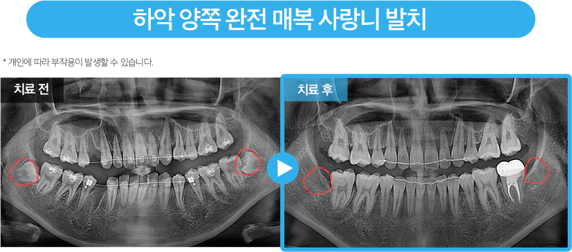 사랑니 증례8