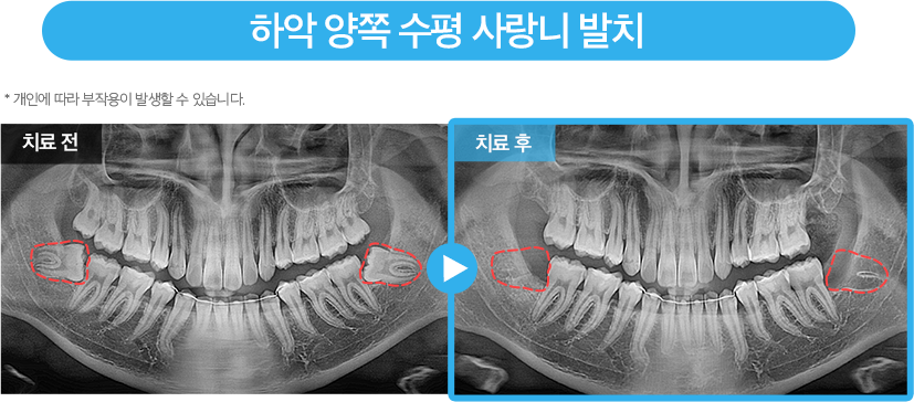 사랑니 증례9