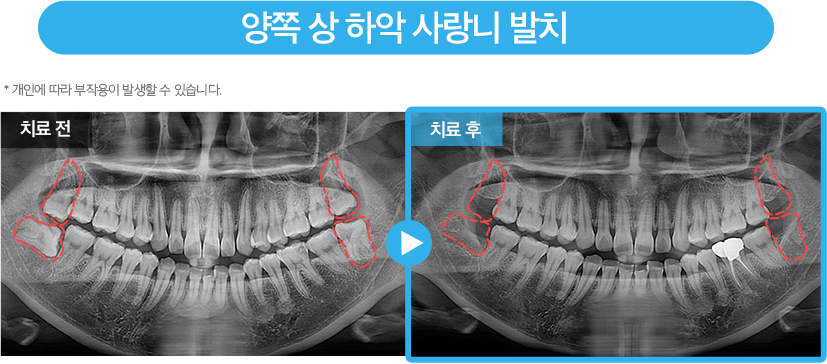 사랑니 증례10