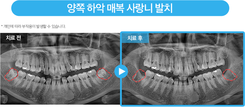 사랑니 증례11