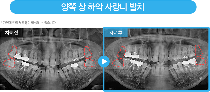 사랑니 증례12