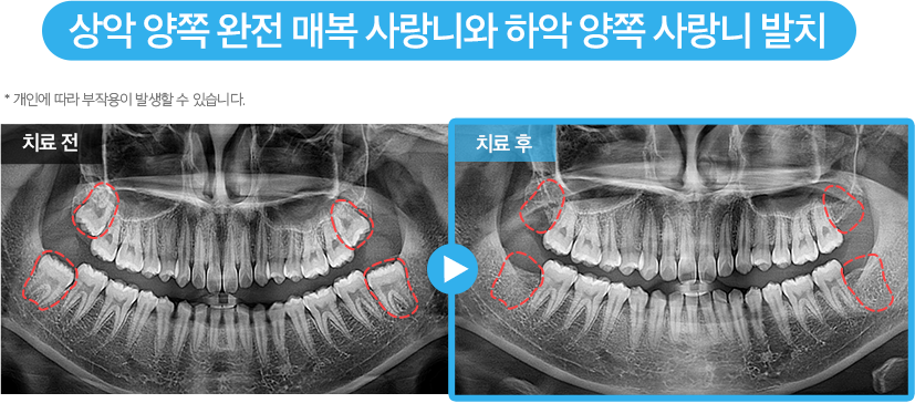 사랑니 증례13