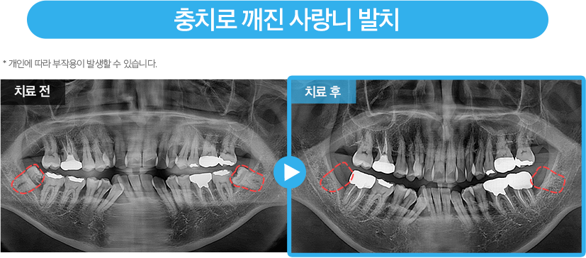 사랑니 증례14