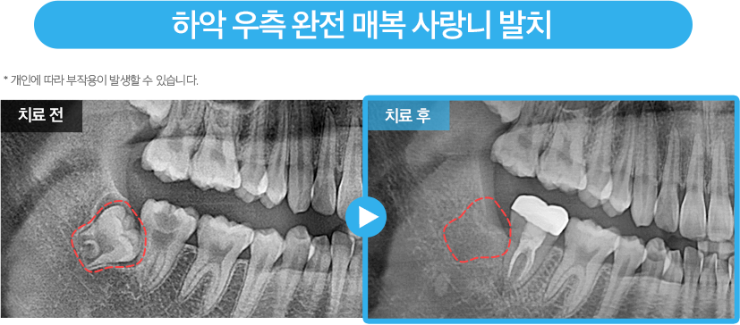 사랑니 증례15