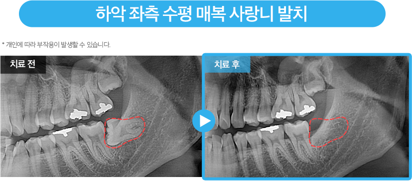 사랑니 증례16