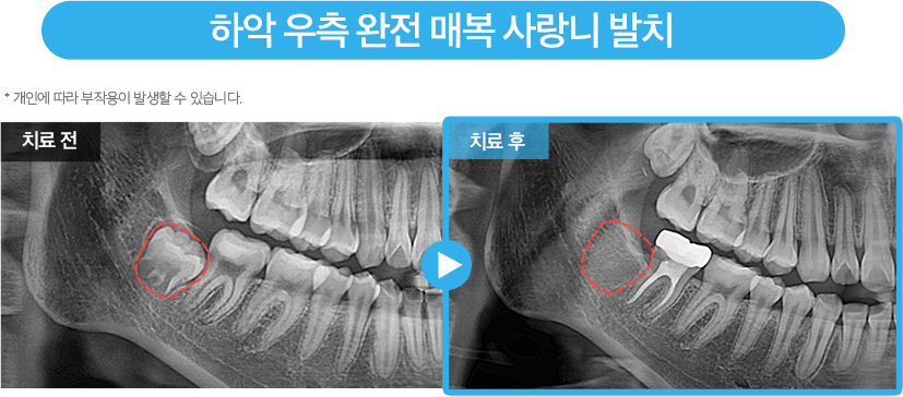 사랑니 증례17