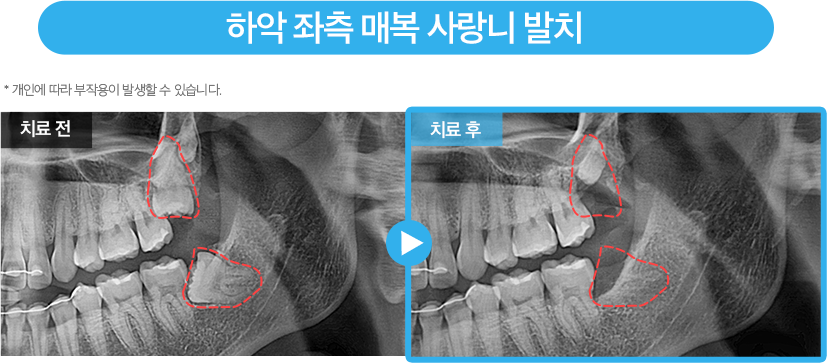 사랑니 증례18